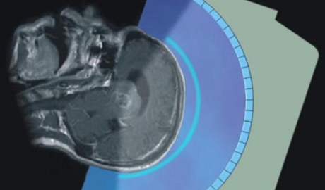 Animace spolenosti InSightec, která metodu vyvinula: Ultrazvukové vlny a mozek pacienta
