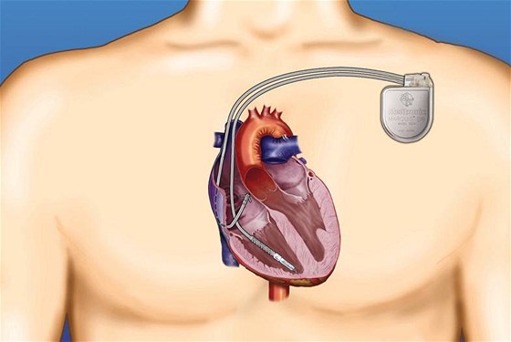 Defibrilátor se vtinou umisuje do podkoí nebo pod prsní sval pod levou...