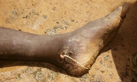 Guinejský červ je vzhledem k nedostatku pitné vody pro Afriku skutečnou pohromou.