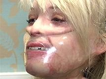 Katie Piperová musí 23 hodin denně nosit plastovou masku, která vyhladí jizvy