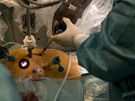 Operace srdce za pomoci robota