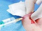Zvtení horního rtu aplikací silikonového implantátu - anestezie