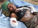 ena s amputovanou rukou leí ped peplnnou nemocnicí v Port-au-Prince. (19. ledna 2010)