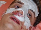 ExVyVolený Martin Hraná� po brutálním napadení 