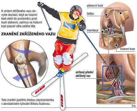 Zrann zkenho vazu Nikoly Sudov