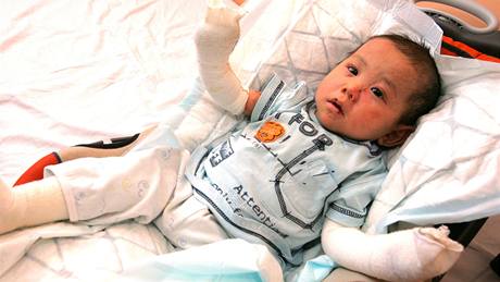 Honzík trpí vzácným onemocn�ním k��e Epidermolysis bullosa, známou také jako...