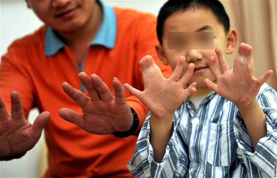 Li Jinpeng ml ped operací sedm prst na levé a osm na pravé ruce