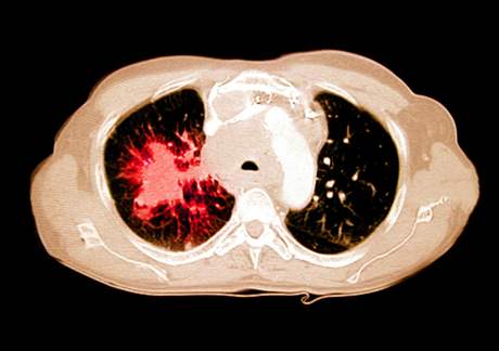 Rakovina plic u kuka - CT hrudnku, kter ukazuje rakovinu plic u 58letho...