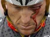 Lance Armstrong s trnou ranou pod okem po pdu pi zvodu Kolem Kalifornie.