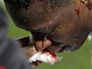 Léka týmu Ghany se snaí zastavit krvácení u fotbalisty Johna Pantsila, který se zranil v zápase s Austrálií.