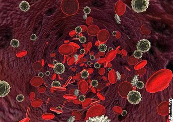 Pi leukémii nejsou bílé krvinky schopné plnit své normální funkce.
