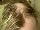 Poátek alopecie: lysiny na hlav Moniky Pospíilové