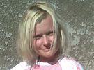 Monika Pospíilová s ástenou alopecií (zaesané lysiny)