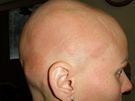 Takto vypadá zánt na pokoce hlavy, který vyvolává speciální vodika pedepsaná lékai v Centru Zdravé vlasy