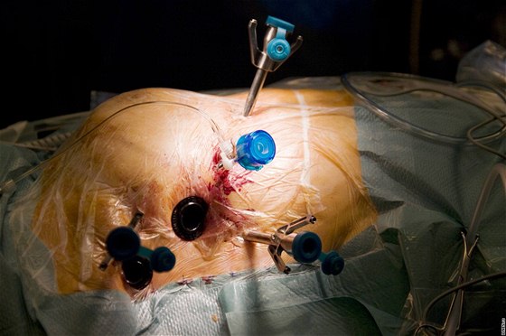 Operace srdce pomocí robota s názvem Da Vinci