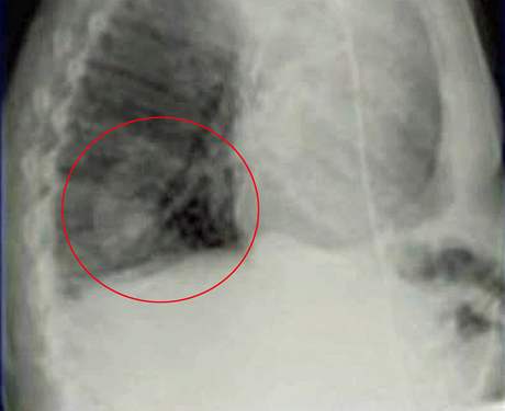 Rentgenový snímek odhalil skoro neskutečnou diagnózu, důchodci v levé plíci rašil hrášek.