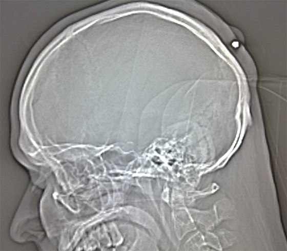 Kulku v hlav Poláka odhalil a rentgenový snímek