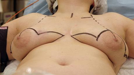 Pacientka ped modelací prsou