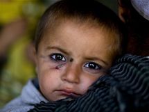 Afghnsk chlapec postien kon leishmanizou ek na oeten v Kbulu.
