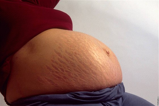 Rychlý váhový přírůstek v těhotenství je často příčinou strií. (Ilustrační fotografie.)