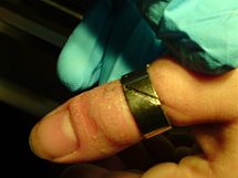 Sundávání prstýnku z oteklého prstu mladé ženy.