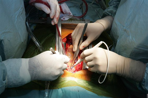 Unikátní operace srdení chlopn v nemocnici U svaté Anny v Brn.