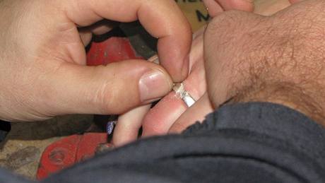Sundávání prstýnku z oteklého prstu mladé eny