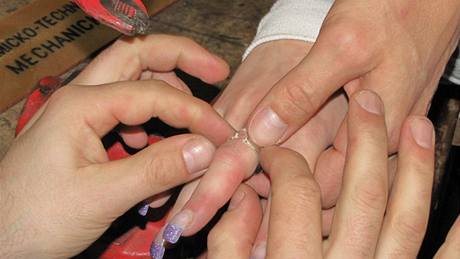 Sundávání prstýnku z oteklého prstu mladé eny