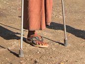 Barmnec bez nohy si piel na kliniku Mae Tao pro pomoc