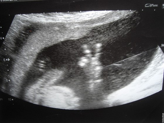 Vzkaz z ultrazvuku: miminko ukázalo "V" v dloze