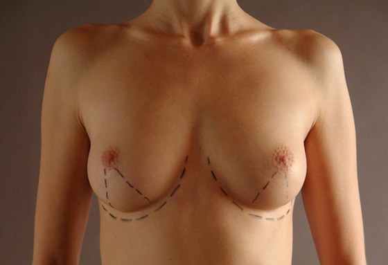Před každou plastickou operací musí žena podstoupit předoperační vyšetření (ilustrační fotografie)