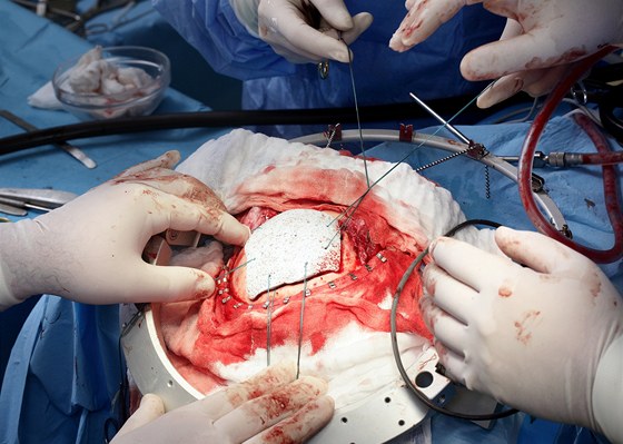 Snímek z operace.