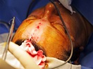 Plastická operace oblieje Medicom VIP - peruení mimických sval u koene nosu, ití