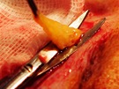 Plastická operace oblieje Medicom VIP - plastika horních víek, odstranní pebyteného tuku
