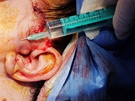Plastická operace oblieje Medicom VIP - facelift and necklift, injekce anestetika s adrenalinem