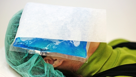 Ošetření akné laserem SmoothBeam chlazení ledem po zákroku