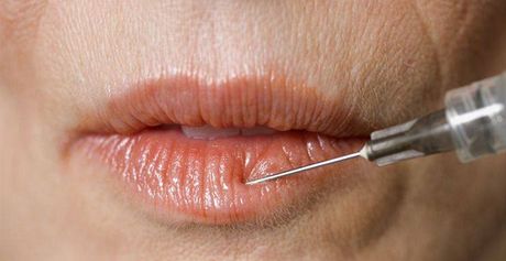 Botoxové injekce jsou v estetické medicín ím dál populárnjí.