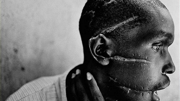 Zranní zpsobená maetou na tvái mue z kmene Hutu pi genocid v africké Rwand. (erven 1994)
