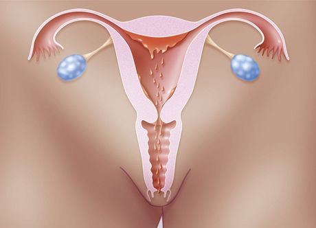 Endometrióza me být píinou neplodnosti (ilustraní snímek)