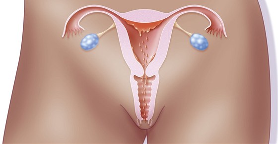 Endometrióza může být příčinou neplodnosti (ilustrační snímek)