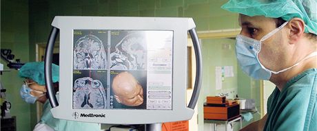Iktová centra nejlépe pomohou pacientm s mozkovou mrtvicí. (Ilustraní snímek)