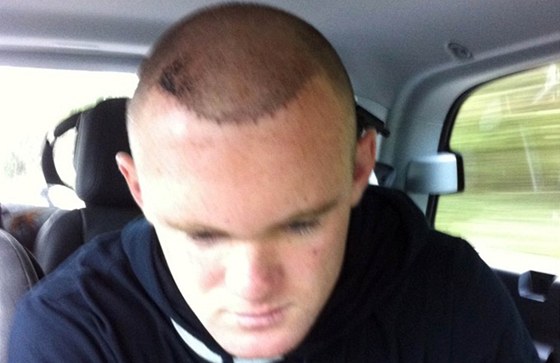 Wayne Rooney zveejnil na Twitteru fotku krátce po transplantaci vlas