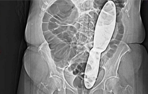 Zdravotníci ivanické nemocnice zapomnli po operaci v tle pacientky 28 centimetr dlouhou kovovou pachtli.
