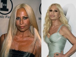 Donatella Versace před a po plastické operaci