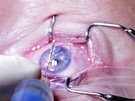 Korekce dioptrické vady pomocí laserové refrakní chirurgie - aplikace