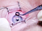 Korekce dioptrické vady pomocí laserové refrakní chirurgie - píprava pro