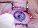 Korekce dioptrické vady pomocí laserové refrakní chirurgie - píprava pro