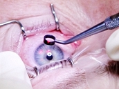 Korekce dioptrické vady pomocí laserové refrakční chirurgie - příprava pro