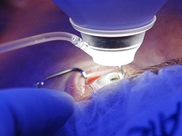 Korekce dioptrické vady pomocí laserové refrakční chirurgie - zaměřování