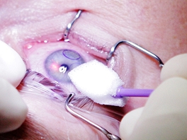 Korekce dioptrick vady pomoc laserov refrakn chirurgie - pprava na